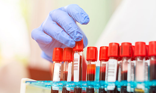 Study links HIE to drop in key protein