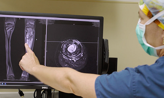 Pioneering limb salvage surgery for children with bone cancer